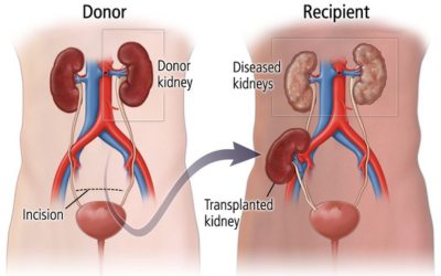 Kidney Transplant Services at AR Kidney Hospital