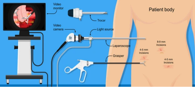 Surgical Procedure